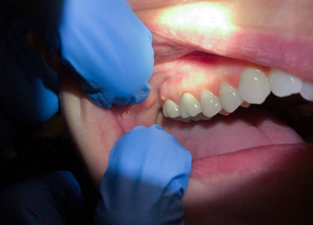 Best Broken or Cracked Tooth Emergency Dentist in Griswold, IA