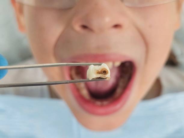 Best Emergency Dentist for Lost Fillings or Crowns in Griswold, IA